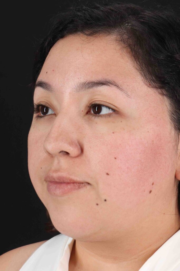 Before - left_oblique