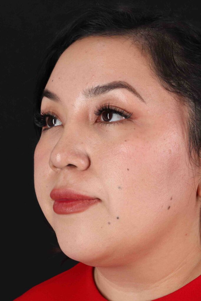 After - left_oblique