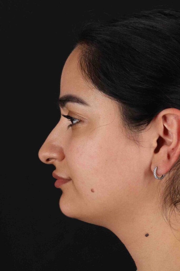 Before - left_lateral