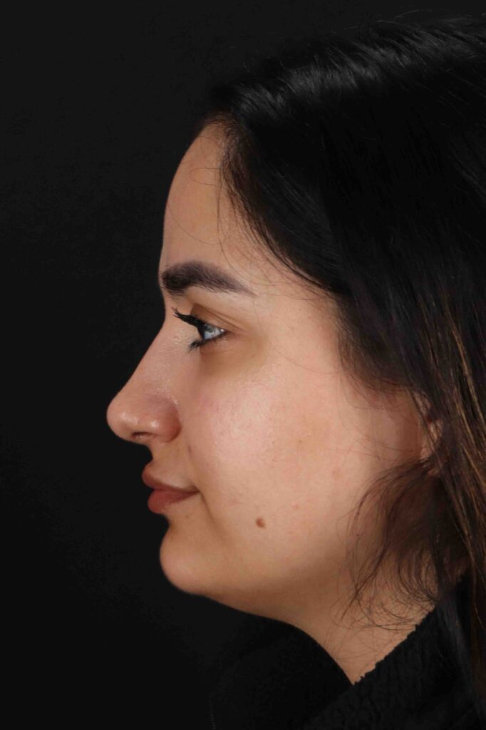 After - left_lateral