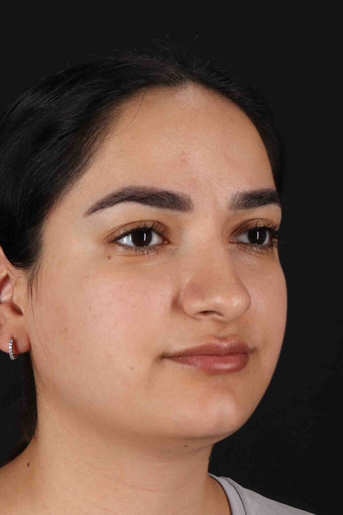 Before - right_oblique