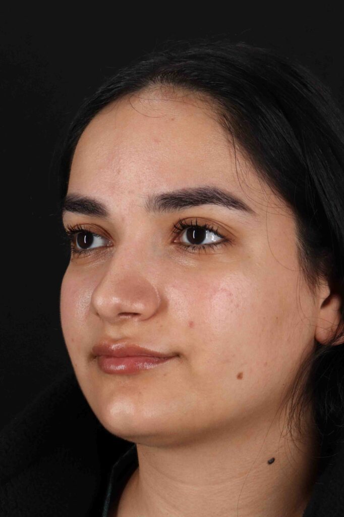 After - left_oblique