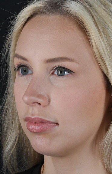 Before - left_oblique