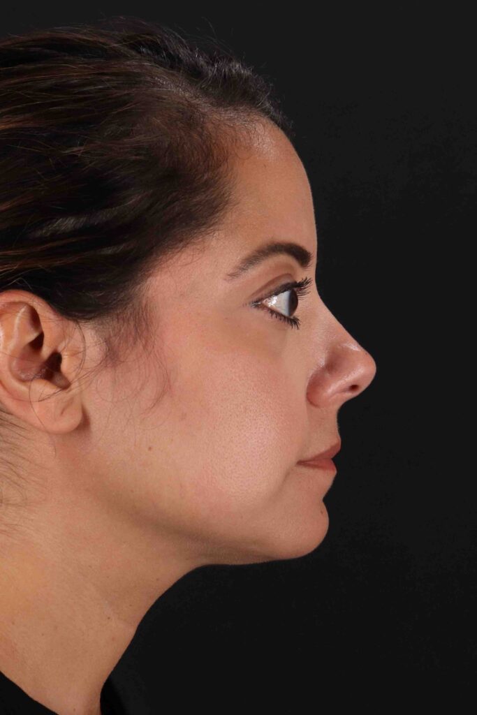 After - right_lateral