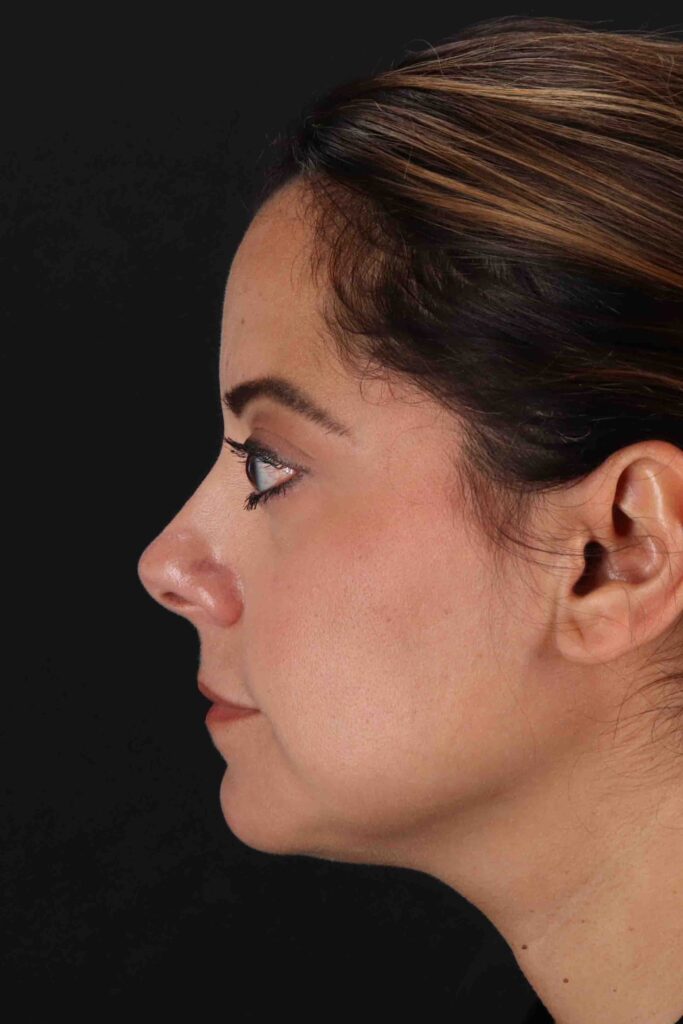 After - left_lateral