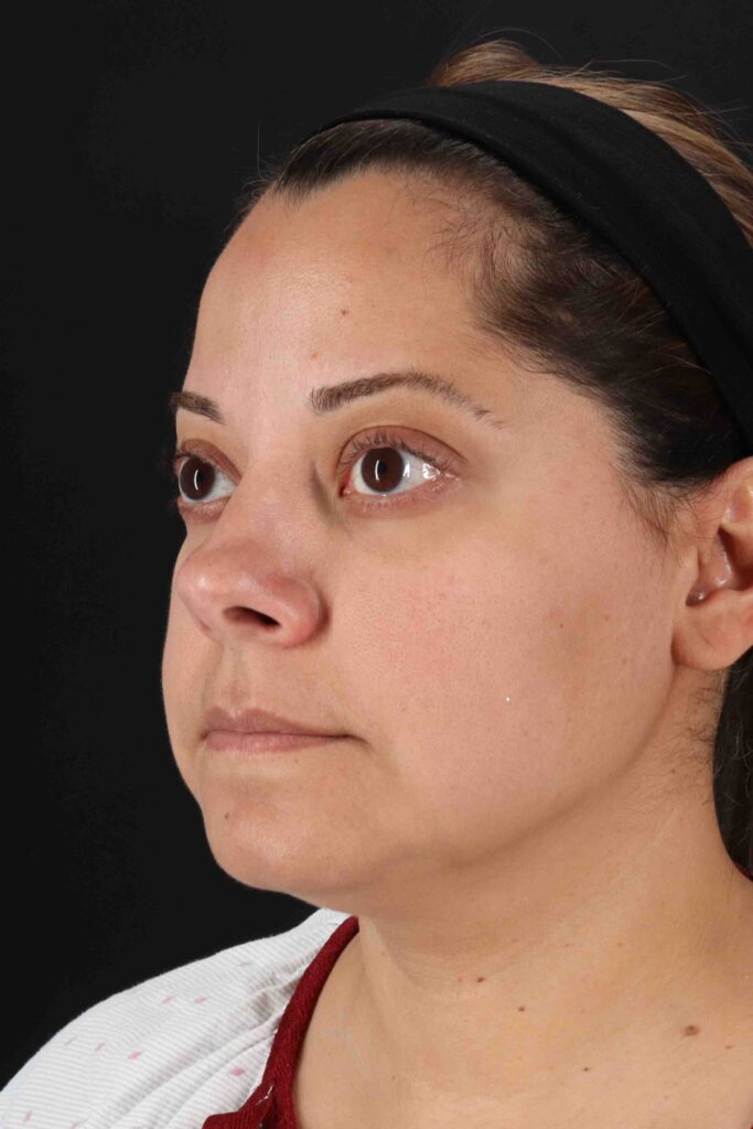 Before - left_oblique