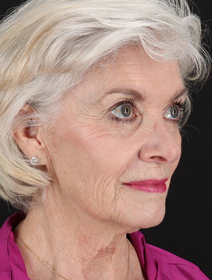 Before - right_oblique