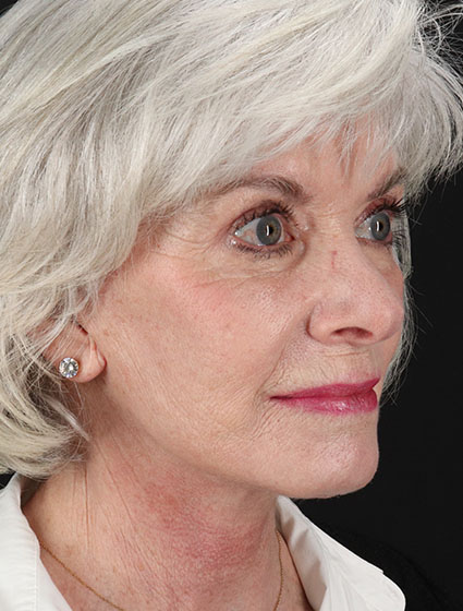 After - right_oblique