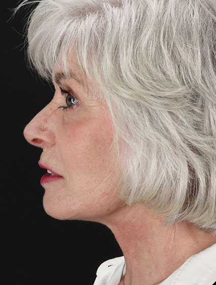 After - left_lateral