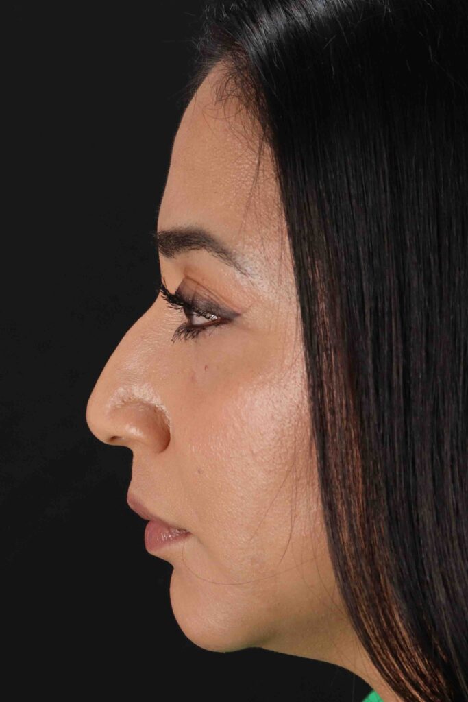 Before - left_lateral