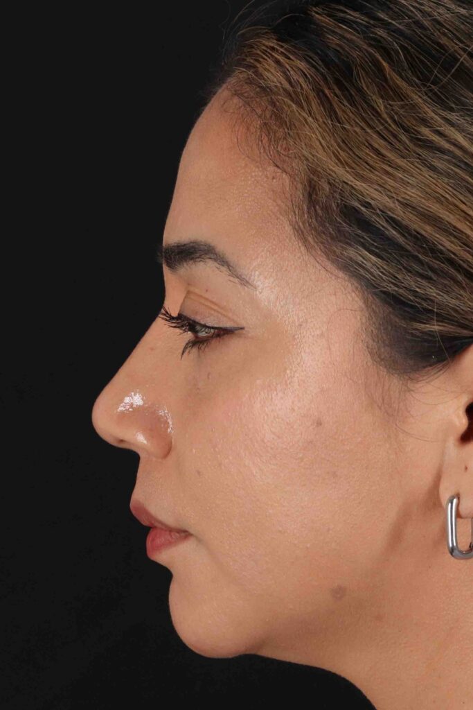 After - left_lateral