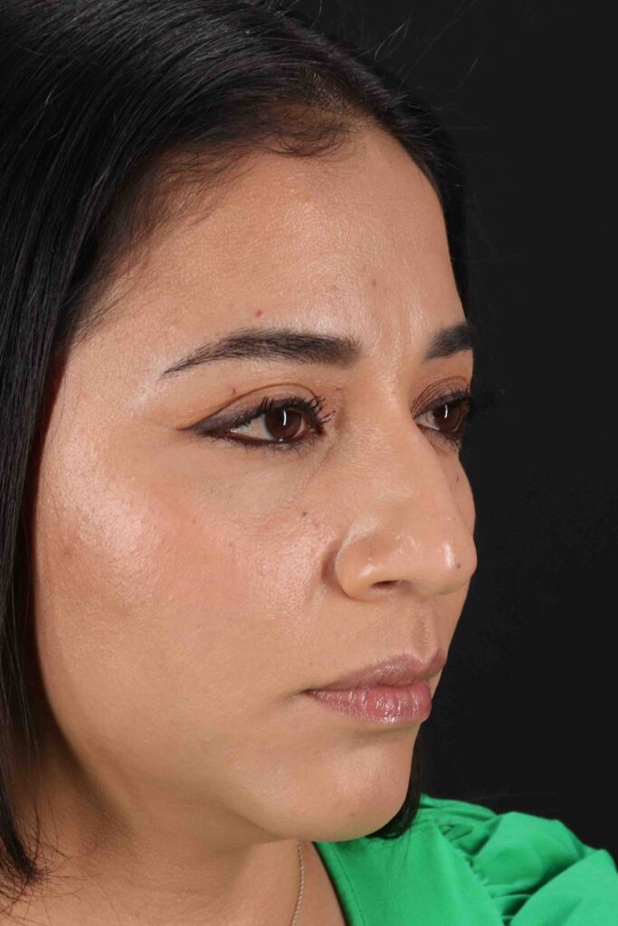 Before - right_oblique