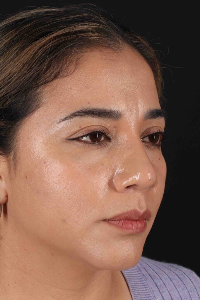 After - right_oblique