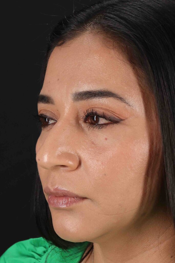 Before - left_oblique