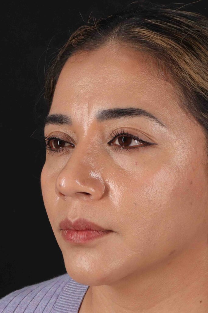 After - left_oblique