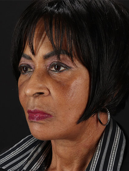 After - left_oblique