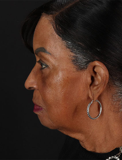 Before - left_lateral