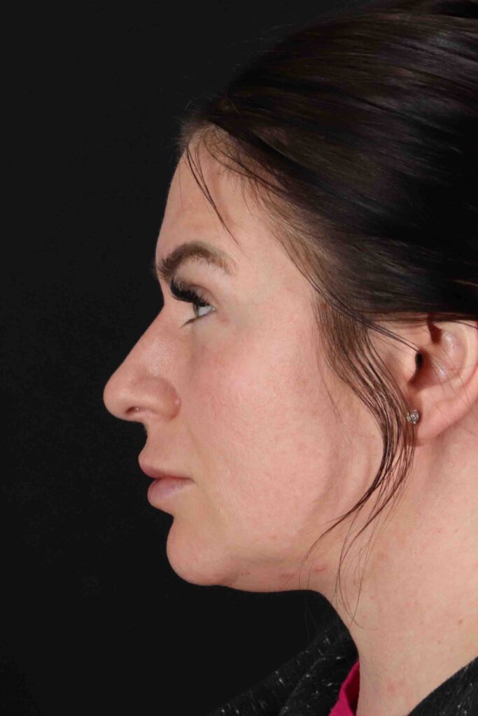 Before - left_lateral