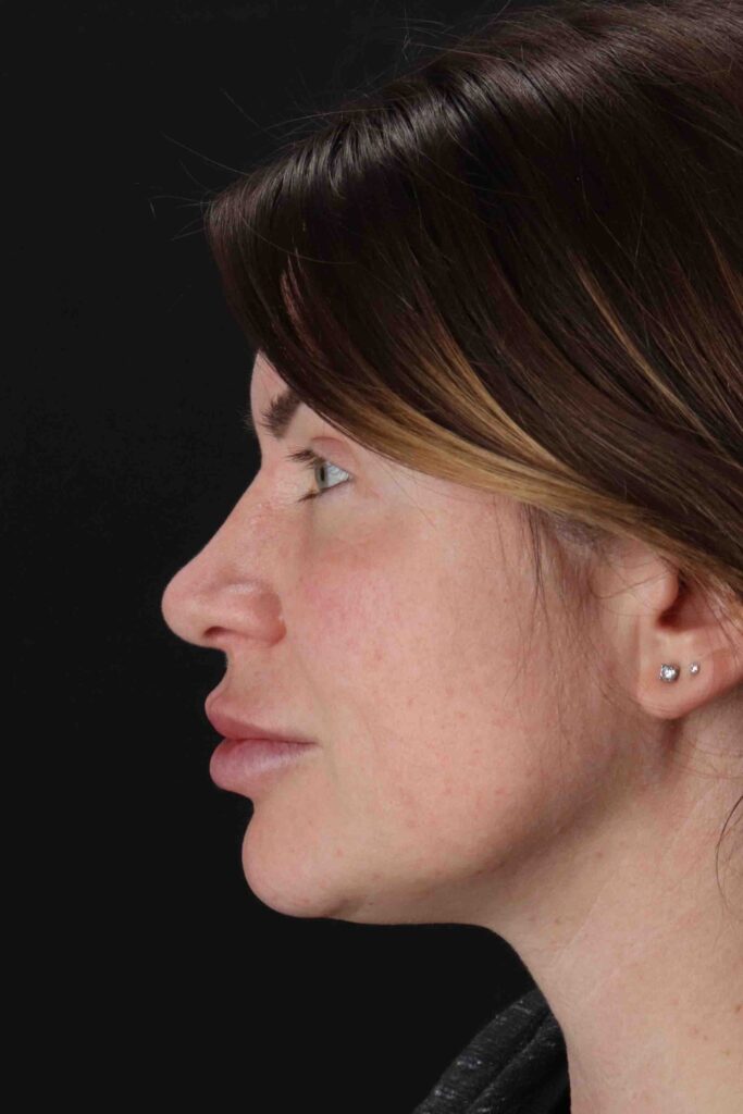 After - left_lateral