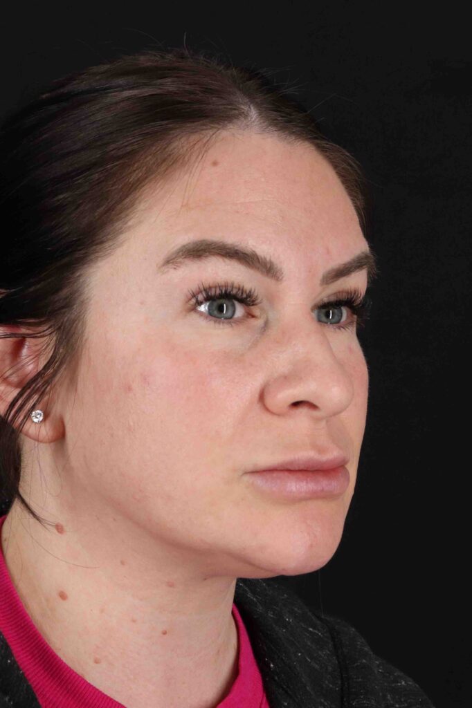 Before - right_oblique