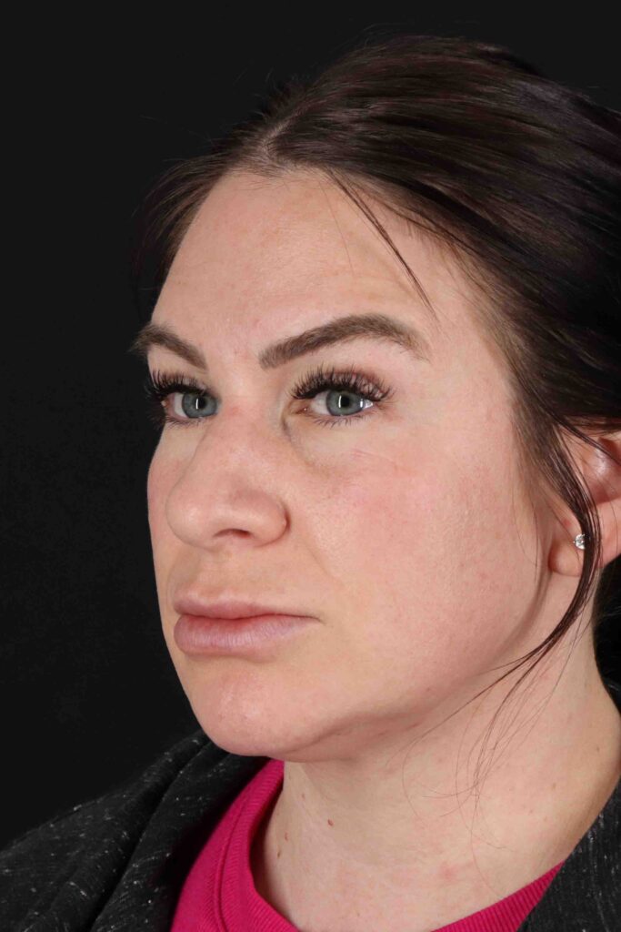 Before - left_oblique