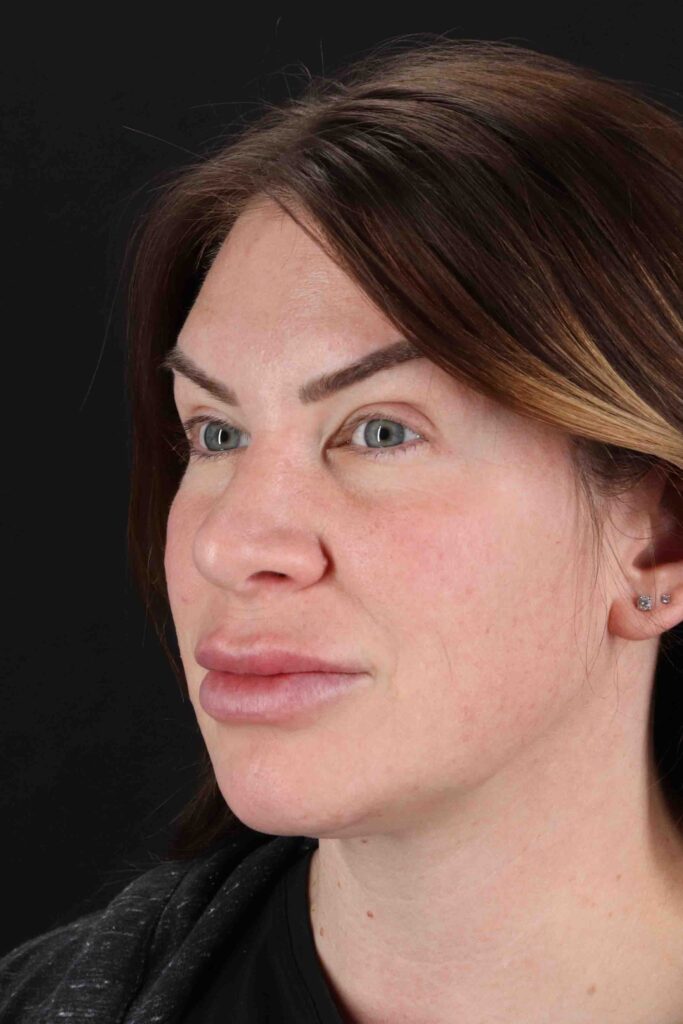 After - left_oblique