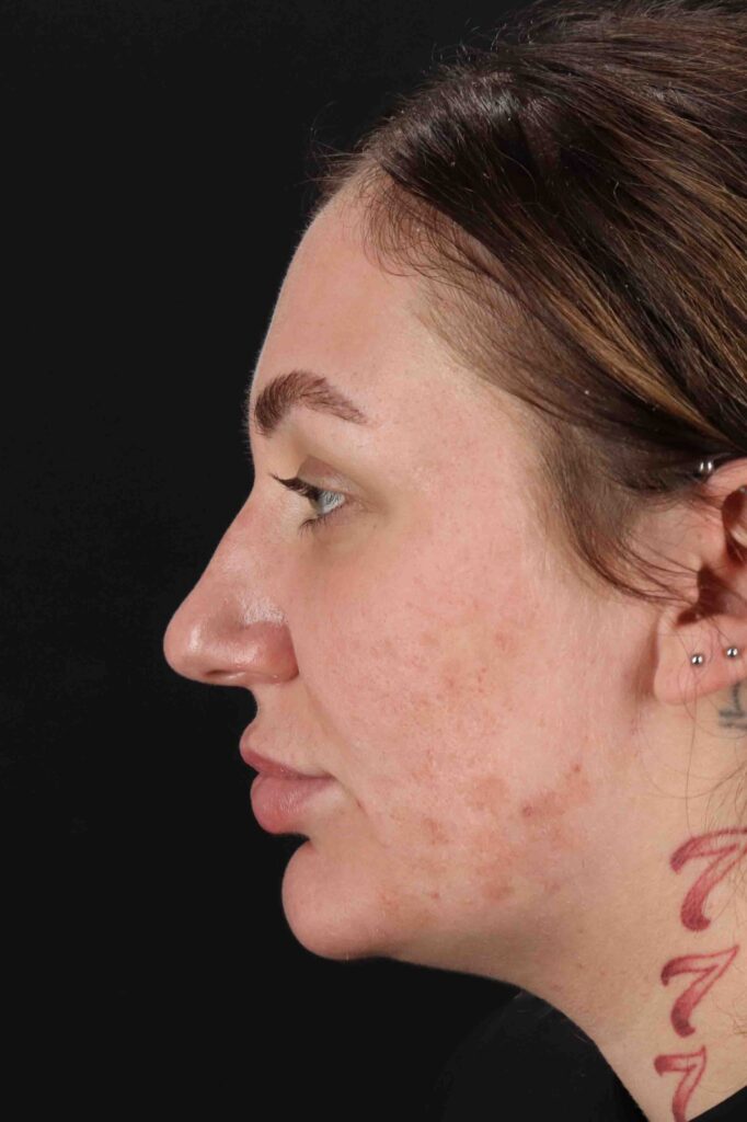 Before - left_lateral