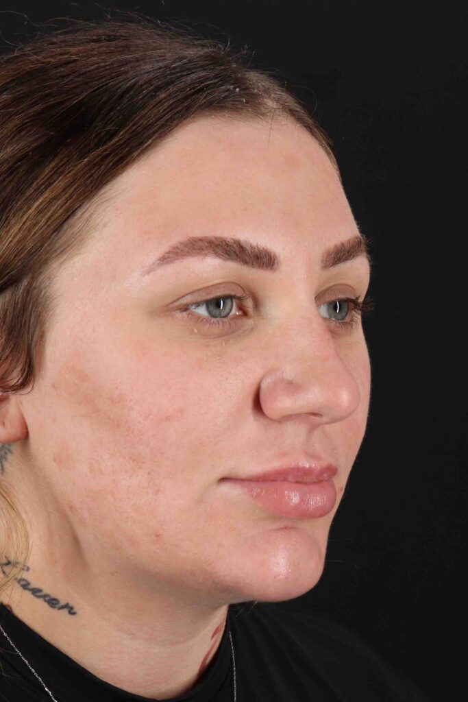 Before - right_oblique