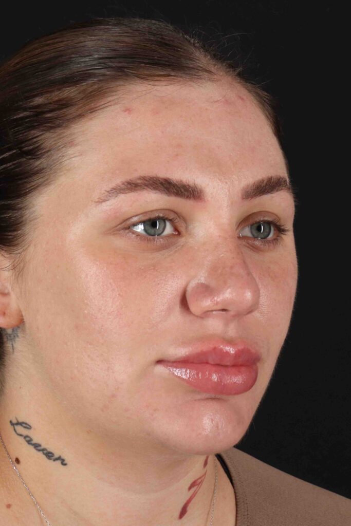 After - right_oblique