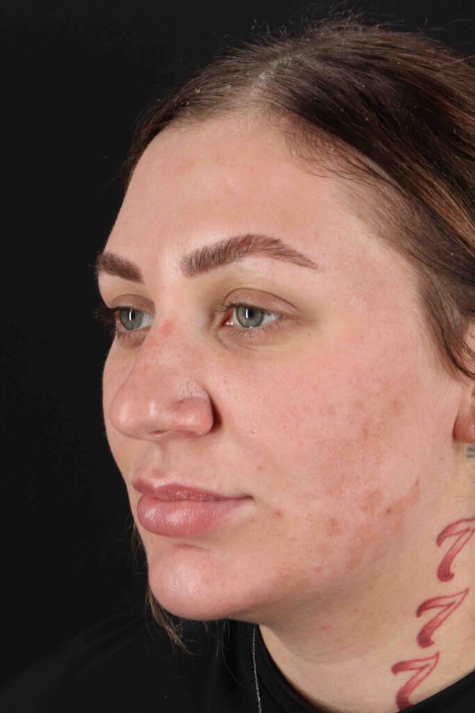 Before - left_oblique