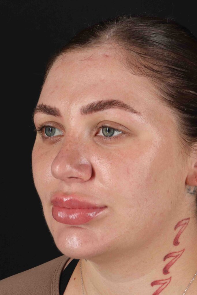 After - left_oblique