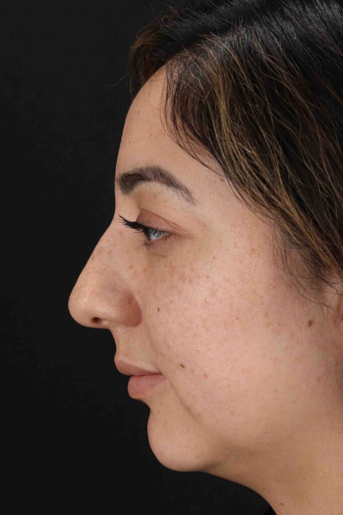 Before - left_lateral