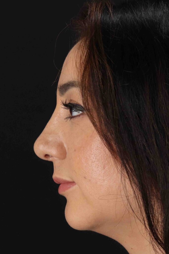 After - left_lateral