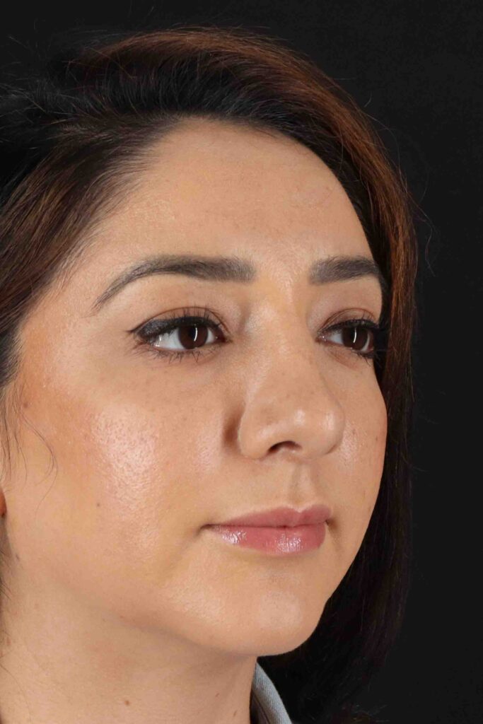 After - right_oblique