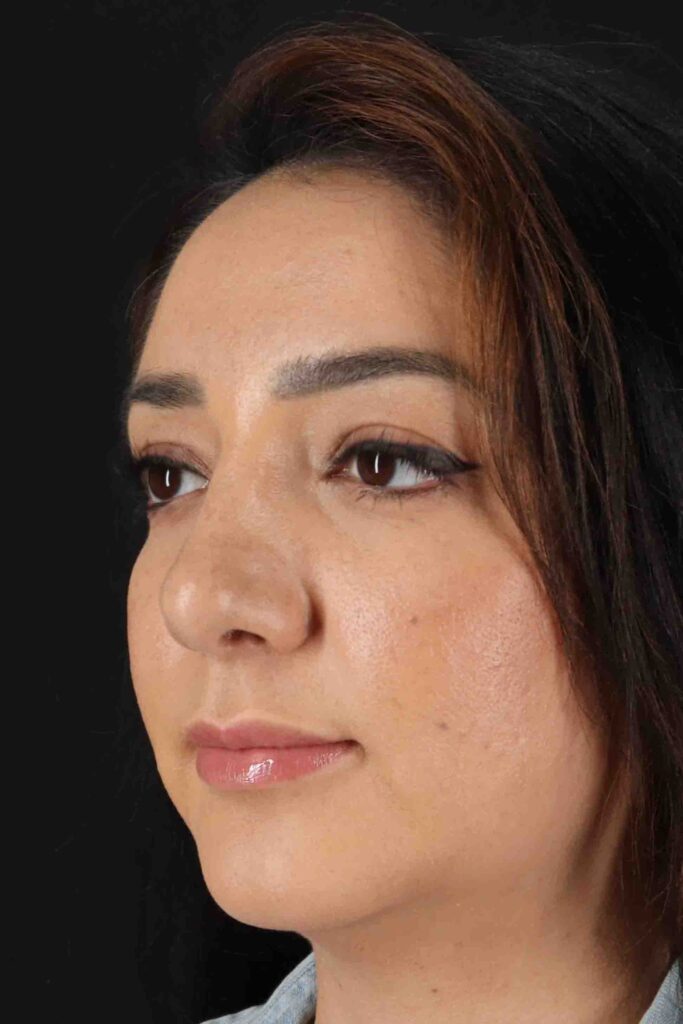 After - left_oblique