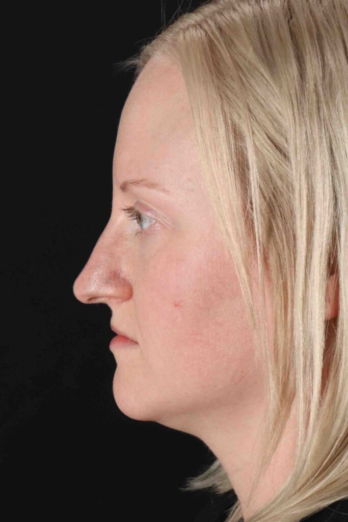 Before - left_lateral