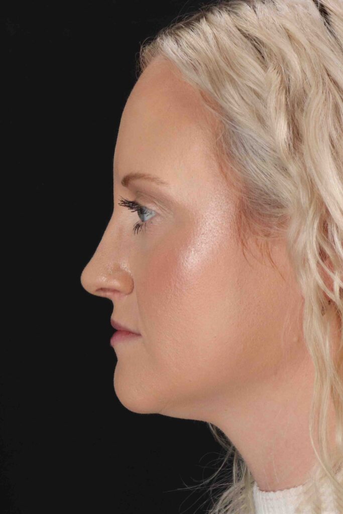 After - left_lateral