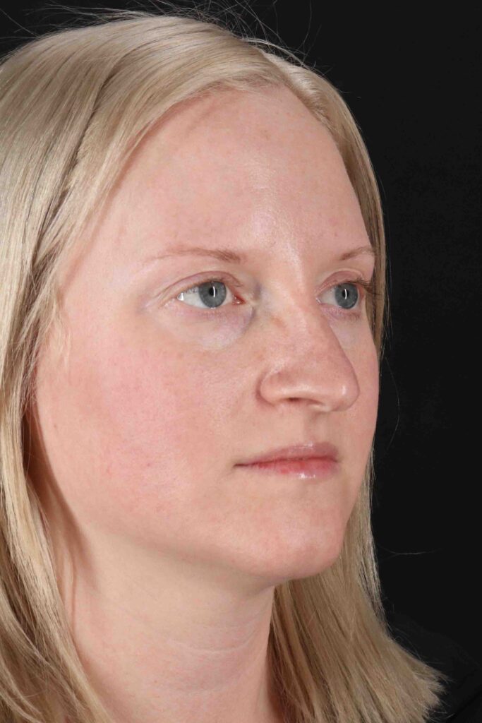 Before - right_oblique