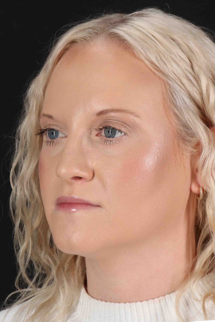 After - left_oblique