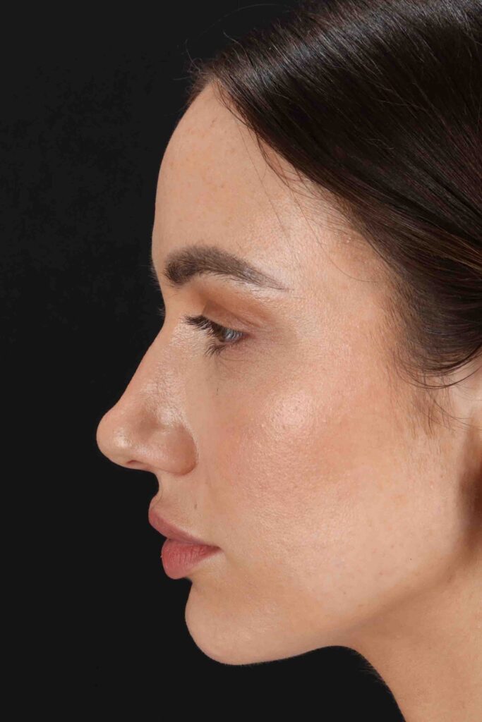 Before - left_lateral