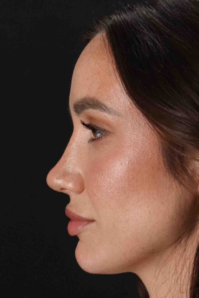 After - left_lateral