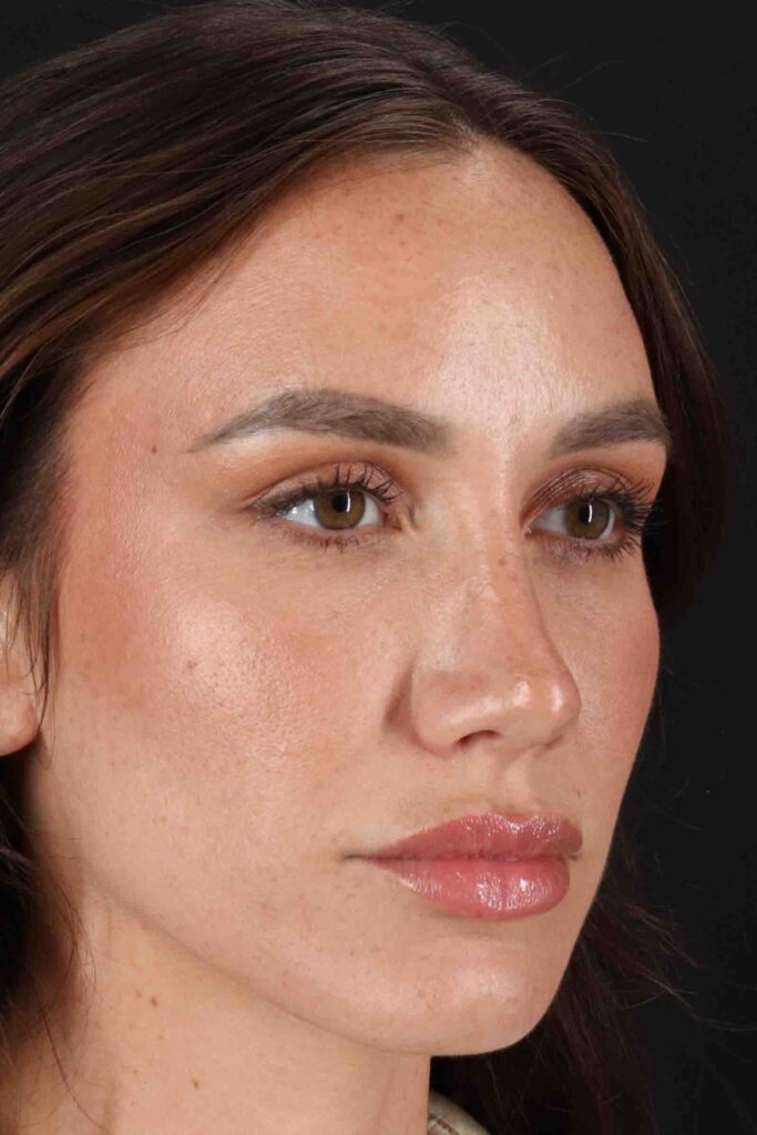 After - right_oblique