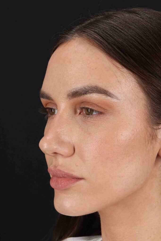 Before - left_oblique