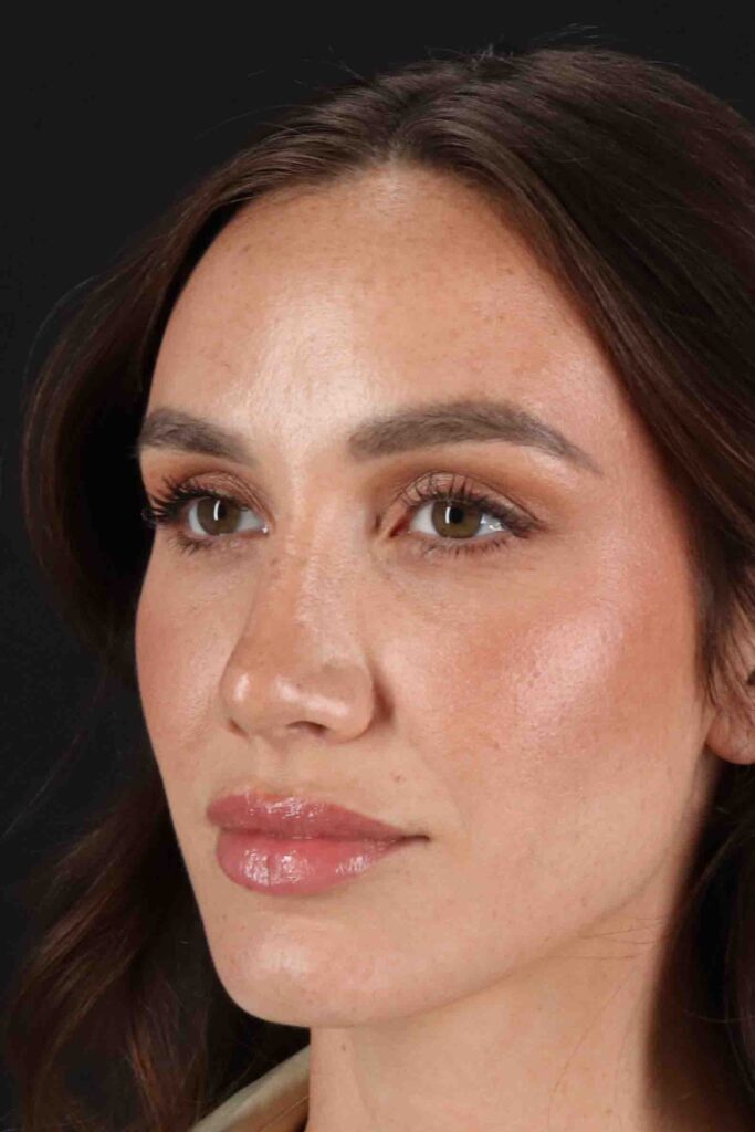 After - left_oblique