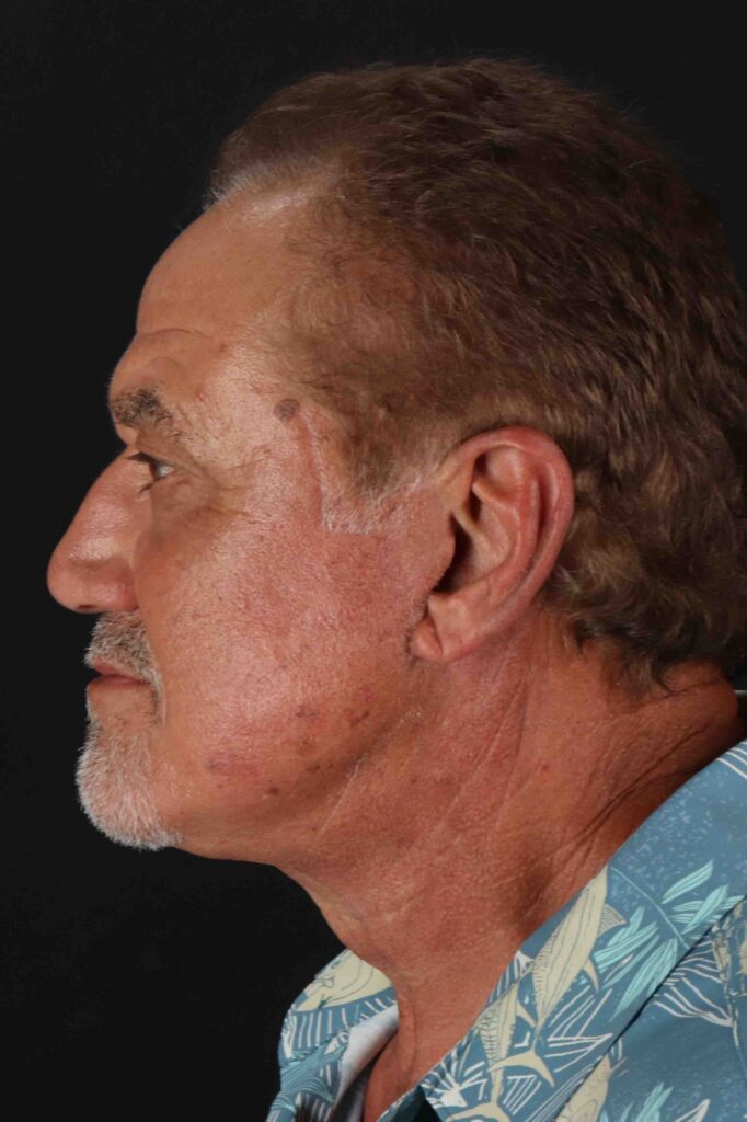 After - left_lateral