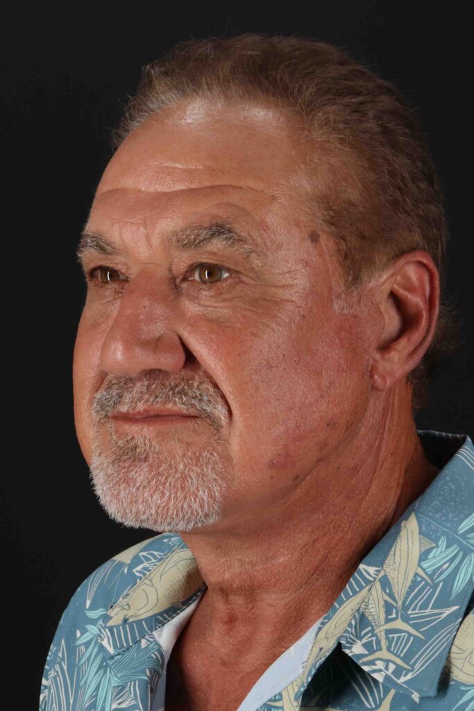 After - left_oblique