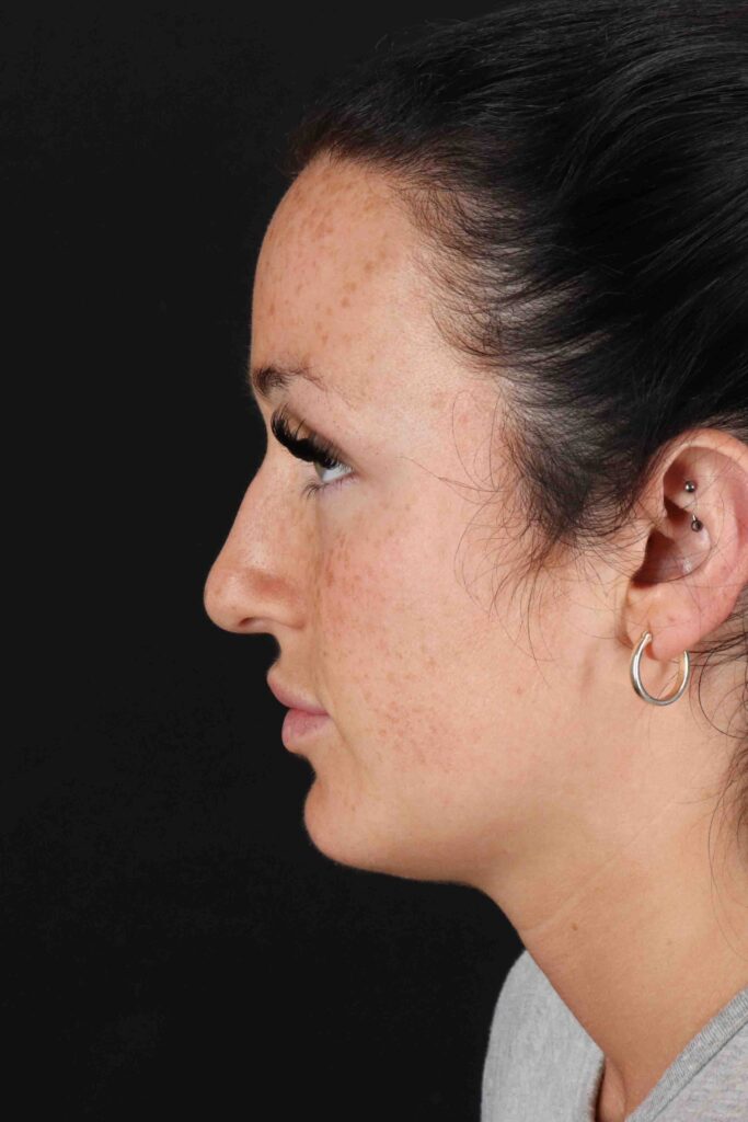 Before - left_lateral