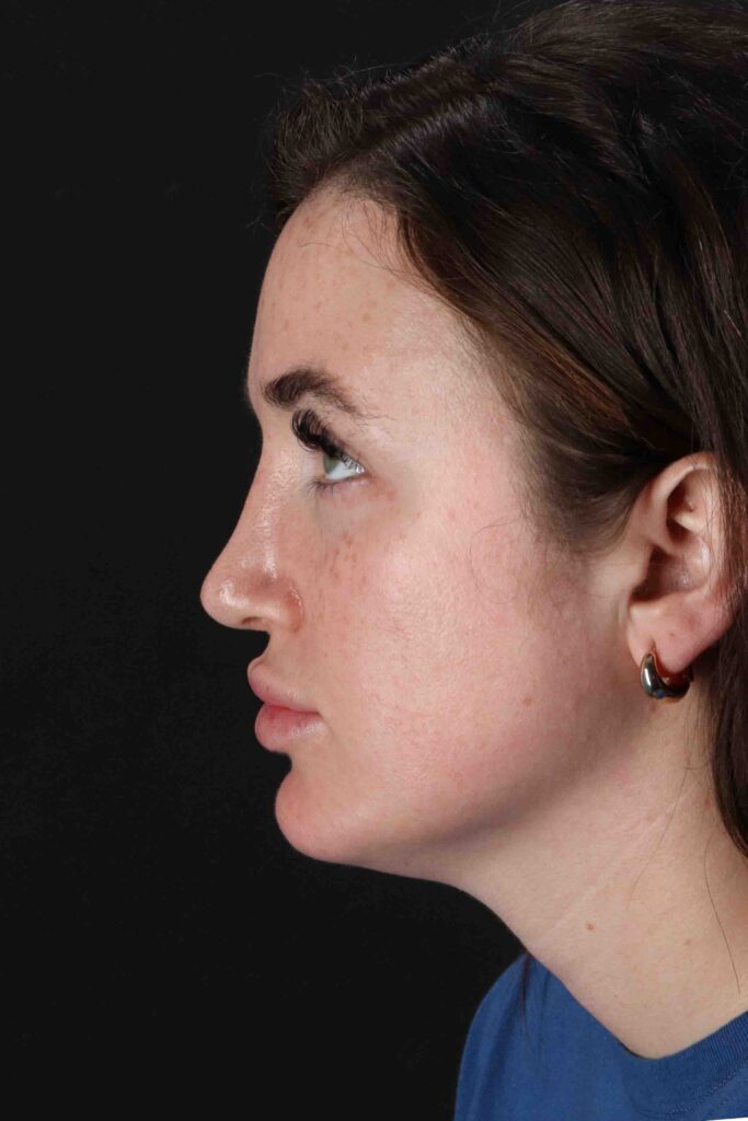 After - left_lateral