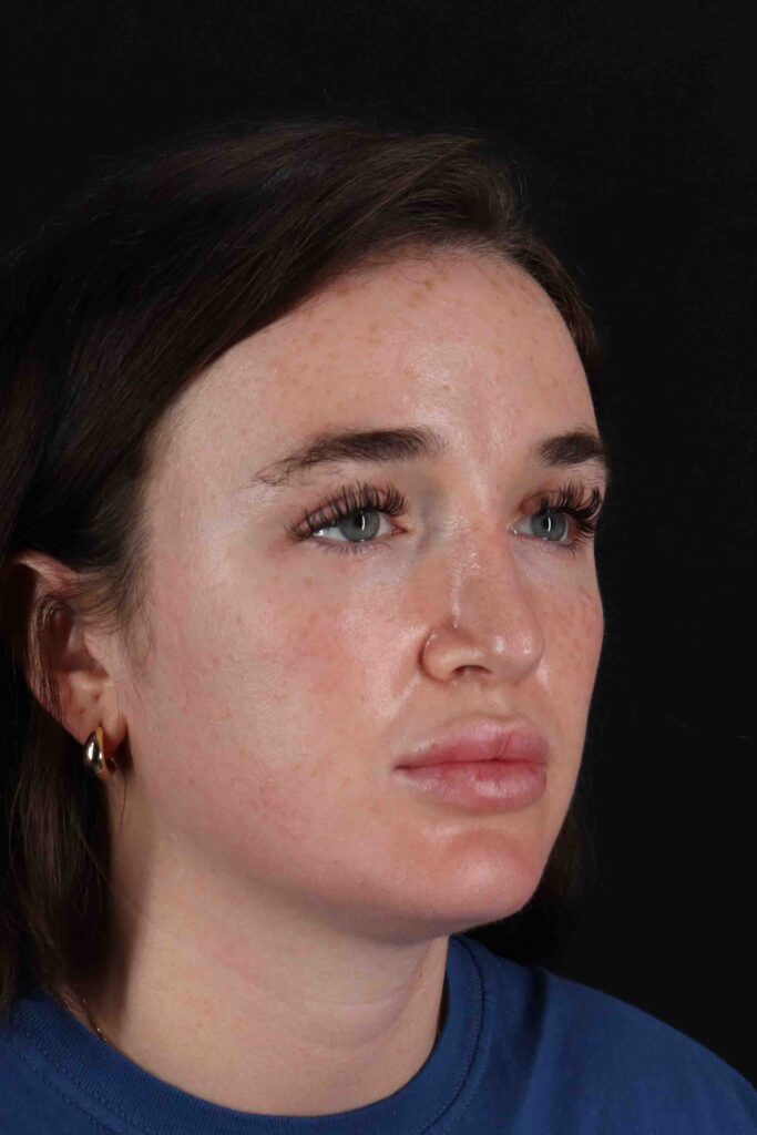 After - right_oblique