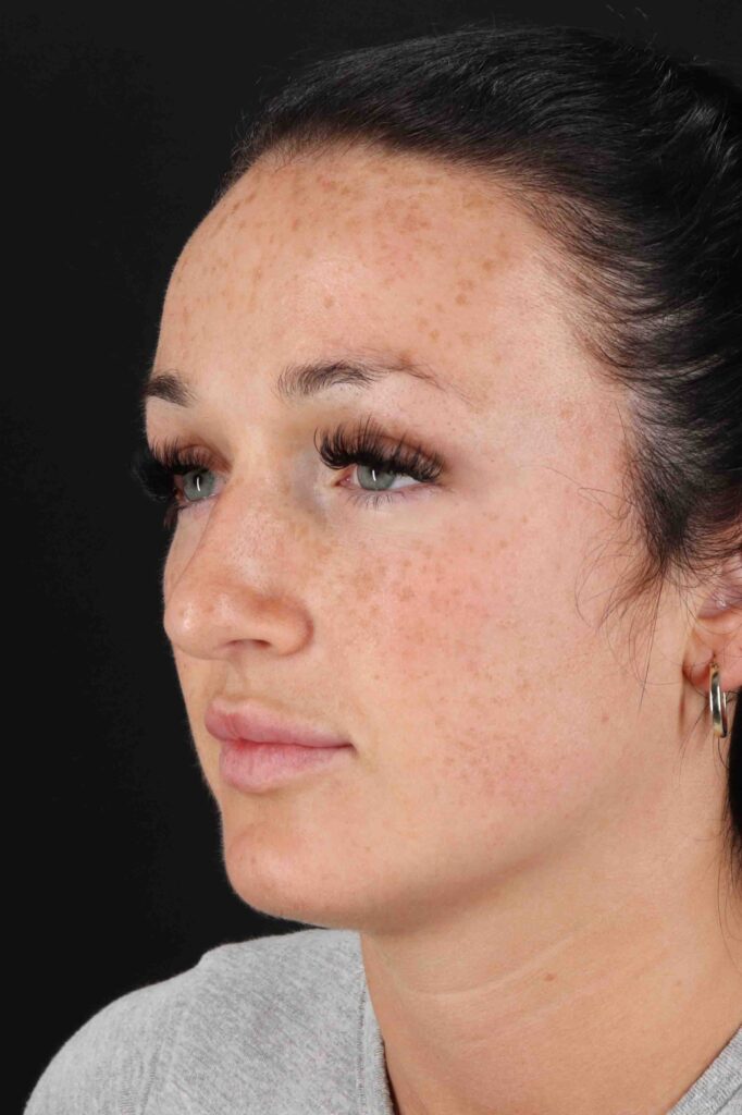 Before - left_oblique